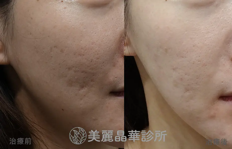 痘疤 凹洞 使用皮下剝離 美麗晶華治療範例分享5