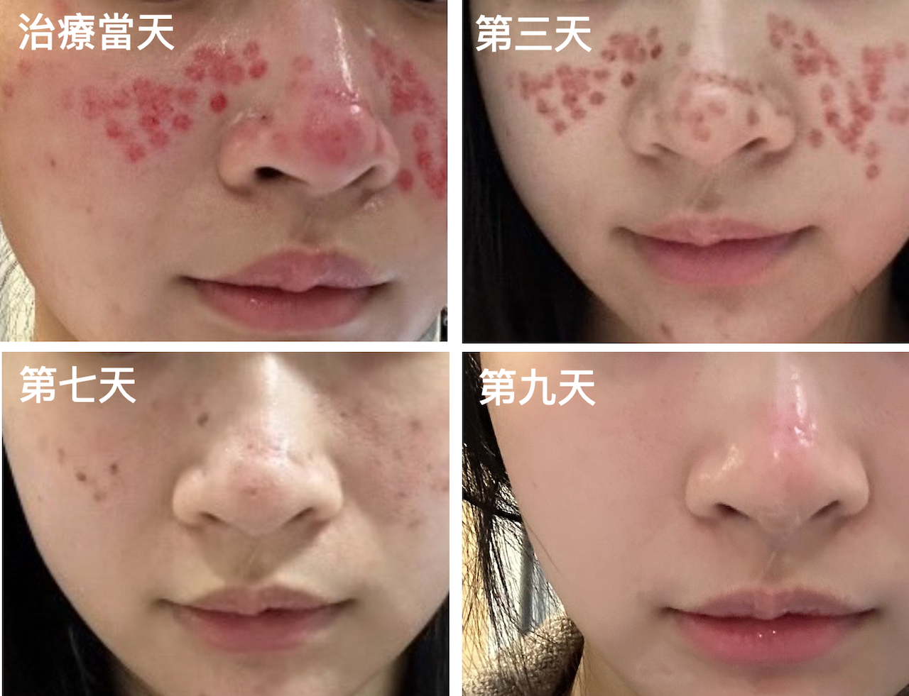 主要想積極改善凹洞、凹疤，術後恢復期狀態