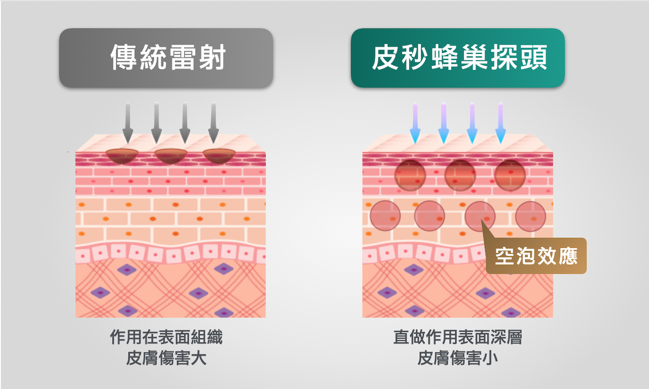 皮秒雷射蜂巢探頭