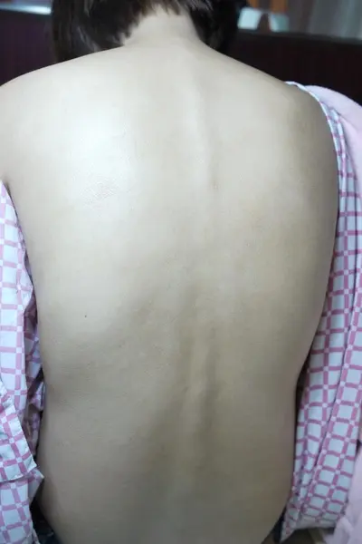 粉餅雷射美背術後立即照