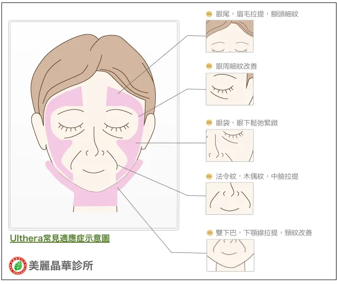 音波常見適應症示意圖