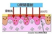 紅寶石雷射Q開關