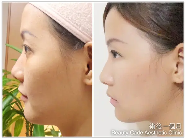 3D聚左旋乳酸術前術後差異比較