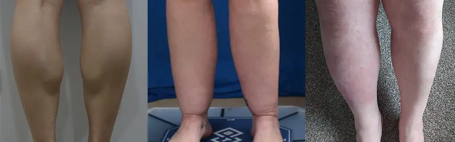 Botox Leg Front Page
