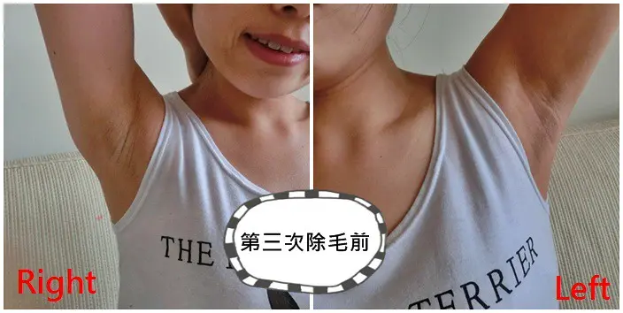 第三次雷射除毛術前