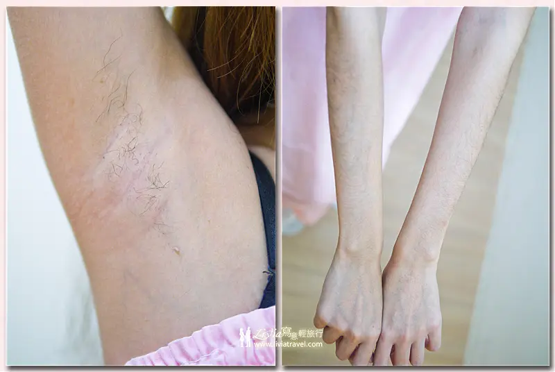 腋下與手部雷射除毛治療前