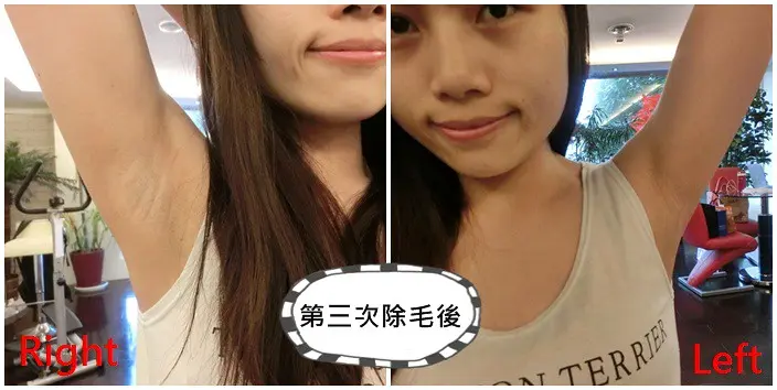第三次雷射除毛術後