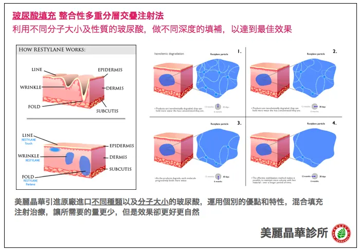 玻尿酸填充整合性多重分層交疊注射法