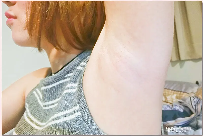 腋下雷射除毛術後近照