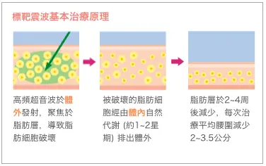 標靶震波溶脂治療原理