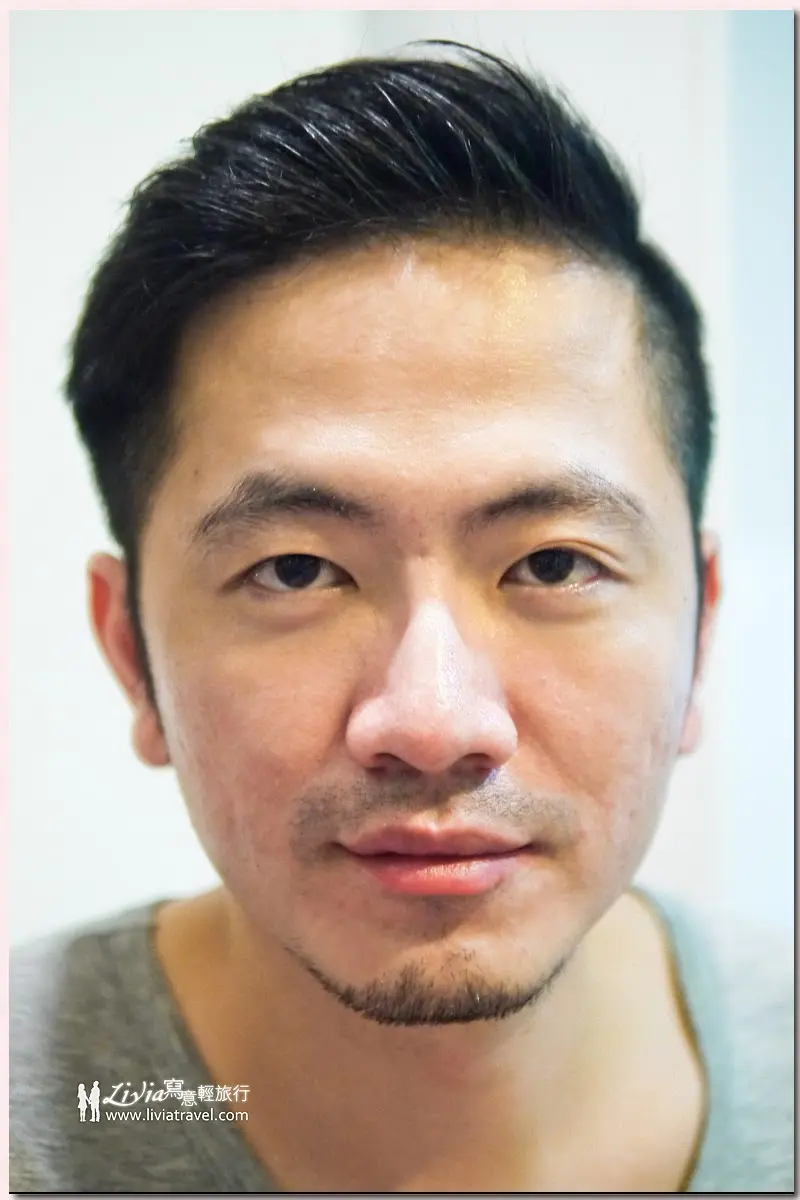 三次飛梭雷射術後