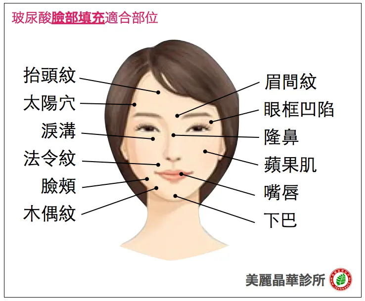 玻尿酸臉部填充適合部位