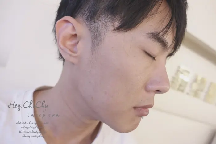 肉毒桿菌瘦臉治療前