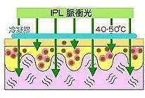 IPL脈衝光