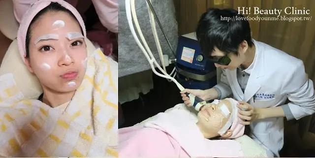 光纖粉餅雷射網路名人小柔推薦治療