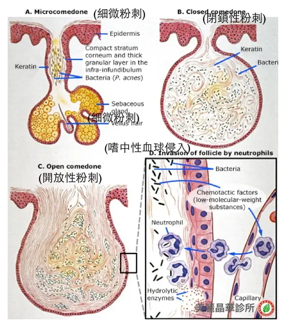 粉刺類型