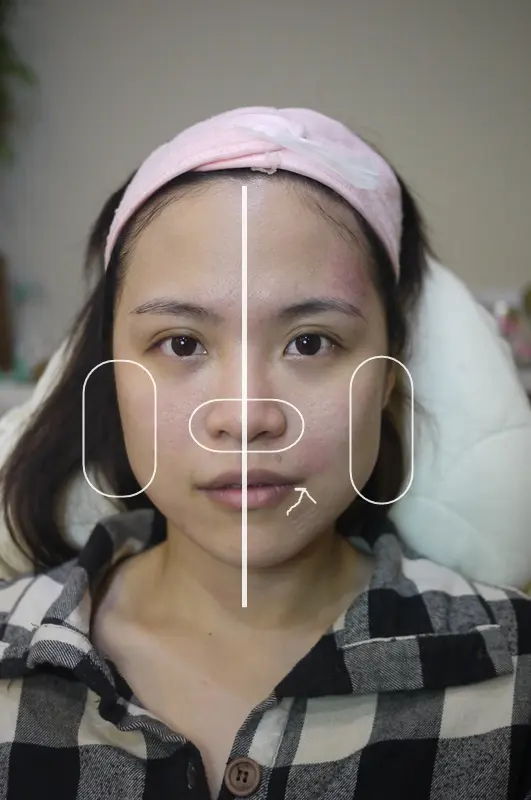 4D埋線拉提治療後拉提效果顯著