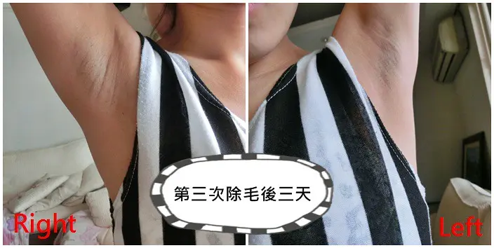 第三次雷射除毛後三天