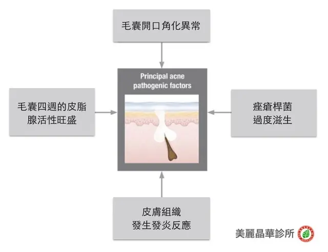 形成痤瘡四大原因