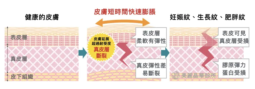 皮膚短時間快速膨脹，就會產生妊娠紋