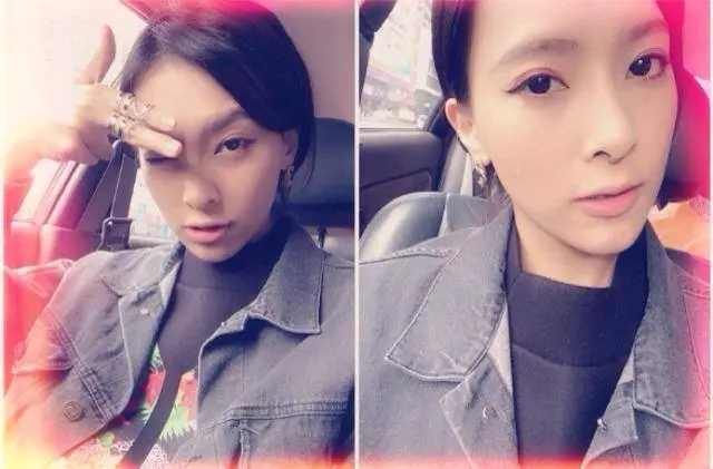 3D聚左旋乳酸治療三個月後臉頰膨潤