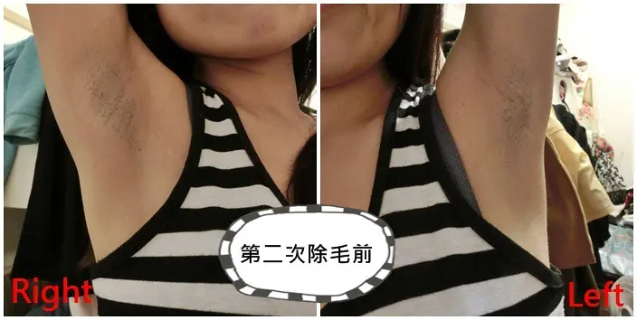 第二次雷射除毛術前
