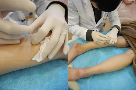 用極細針頭 肉毒小腿 瘦小腿 疼痛降低