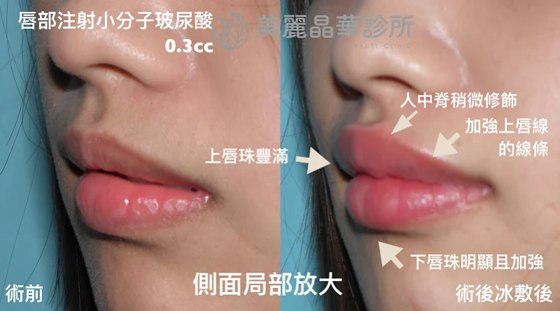 玻尿酸豐唇術後左側追蹤