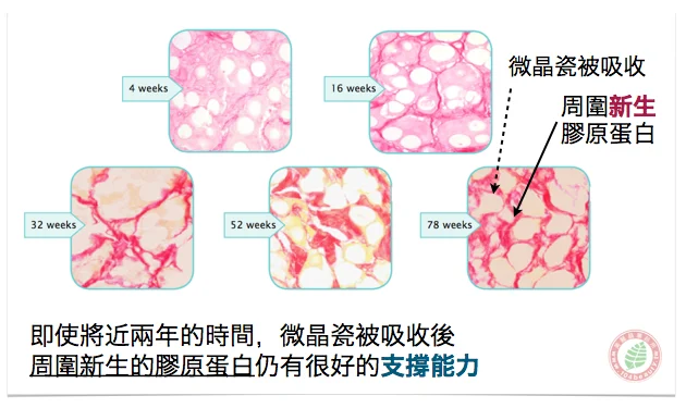 晶亮瓷(微晶瓷)吸收後周圍新生膠原蛋白仍有好的支撐