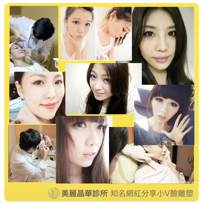 肉毒小V臉眾多網路名人推薦治療