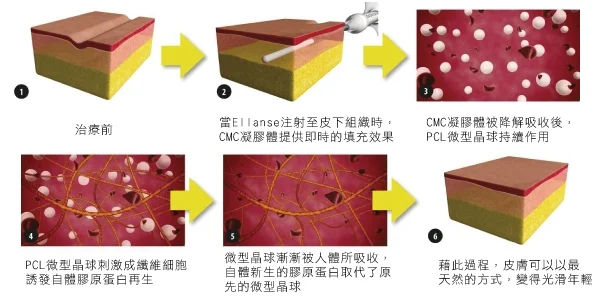 洢蓮絲Ellanse治療原理示意圖
