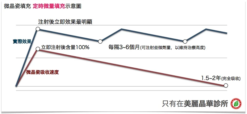 晶亮瓷(微晶瓷)定時微量填充示意圖