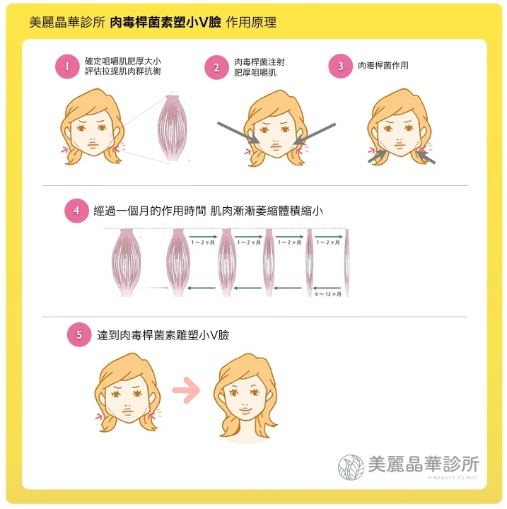肉毒桿菌雕塑小V臉作用原理