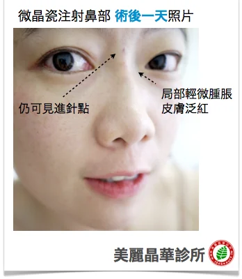 晶亮瓷(微晶瓷)術後一天照片
