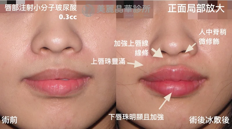 玻尿酸豐唇術後正面追蹤