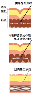 肉毒桿菌素作用原理