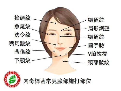 肉毒桿菌常見臉部施打部位
