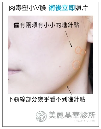 肉毒小V臉術後立即照