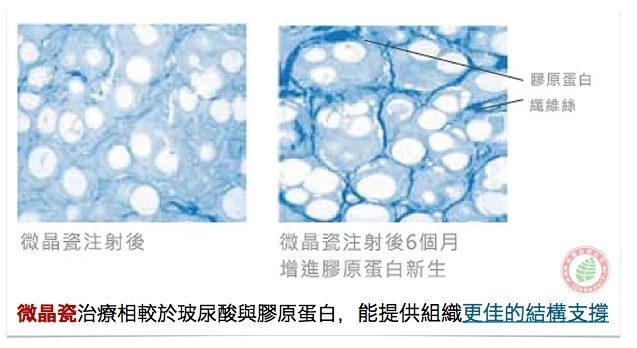 晶亮瓷(微晶瓷)注射提供更佳支撐結構